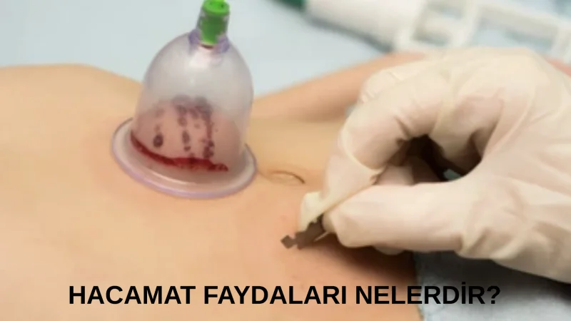 Hacamat Faydaları